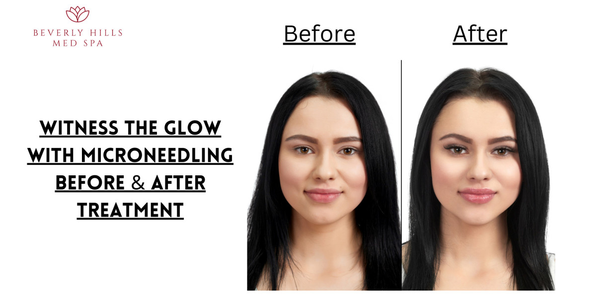 Witness the Glow with Microneedling Before & After Treatment