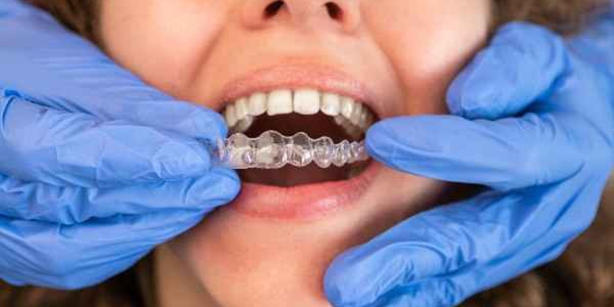 How Invisalign Speeds Up Mild to Moderate Orthodontic Treatment