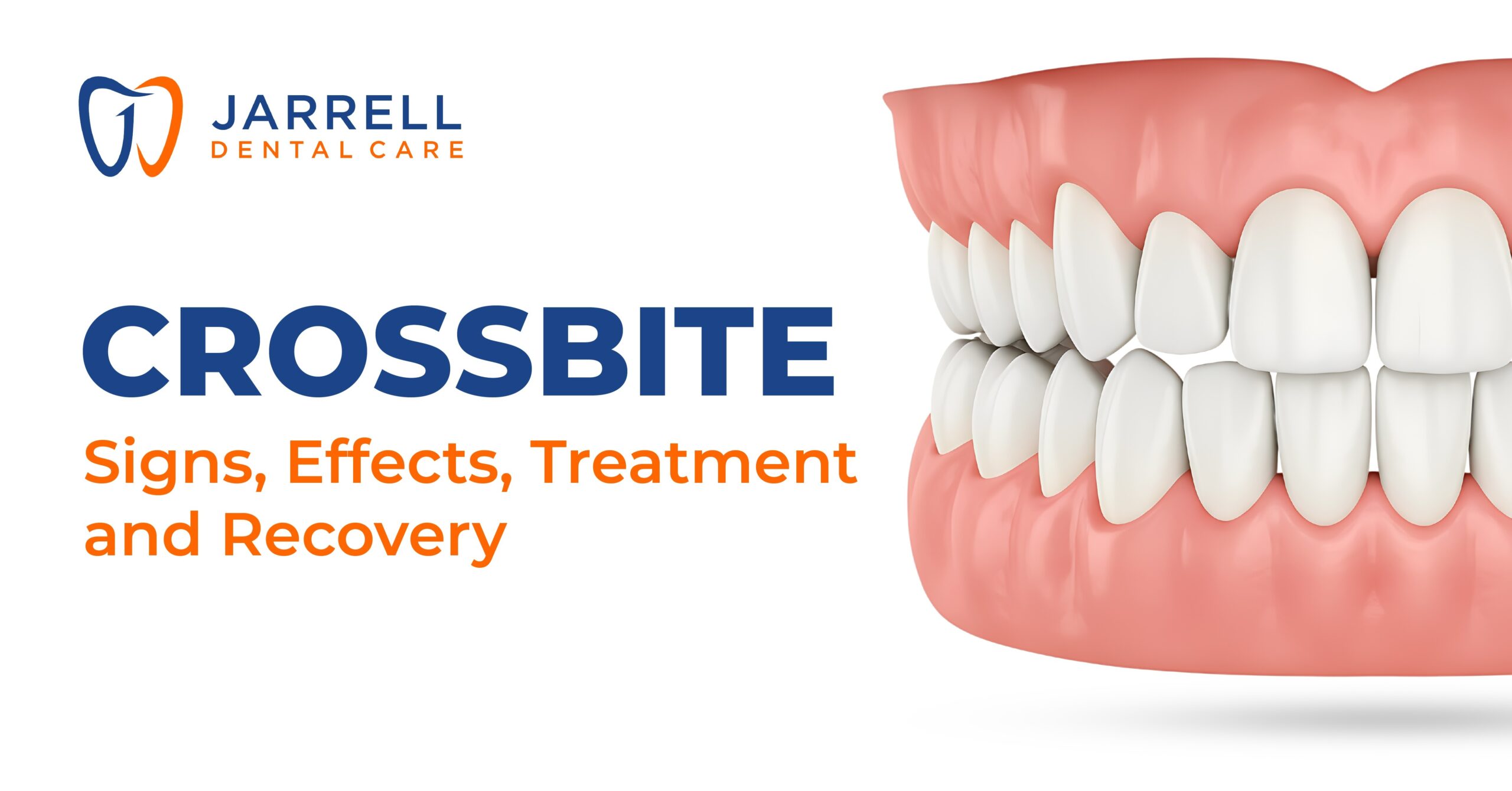 Crossbite – Signs, Effects, Treatment and Recovery