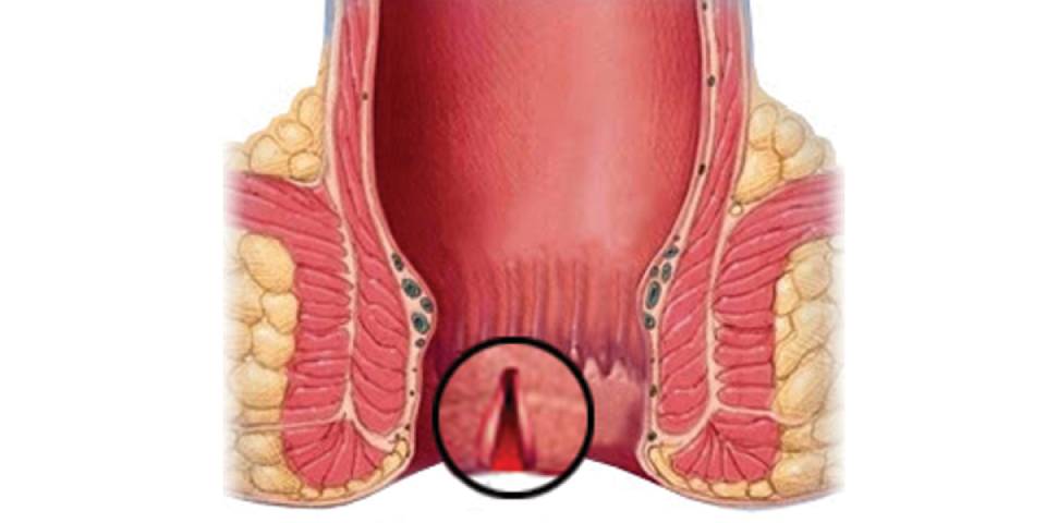 Fissure Treatment In Bangalore | Dr Bhushan Chittawadagi- Best Gastroenterologist in Bangalore