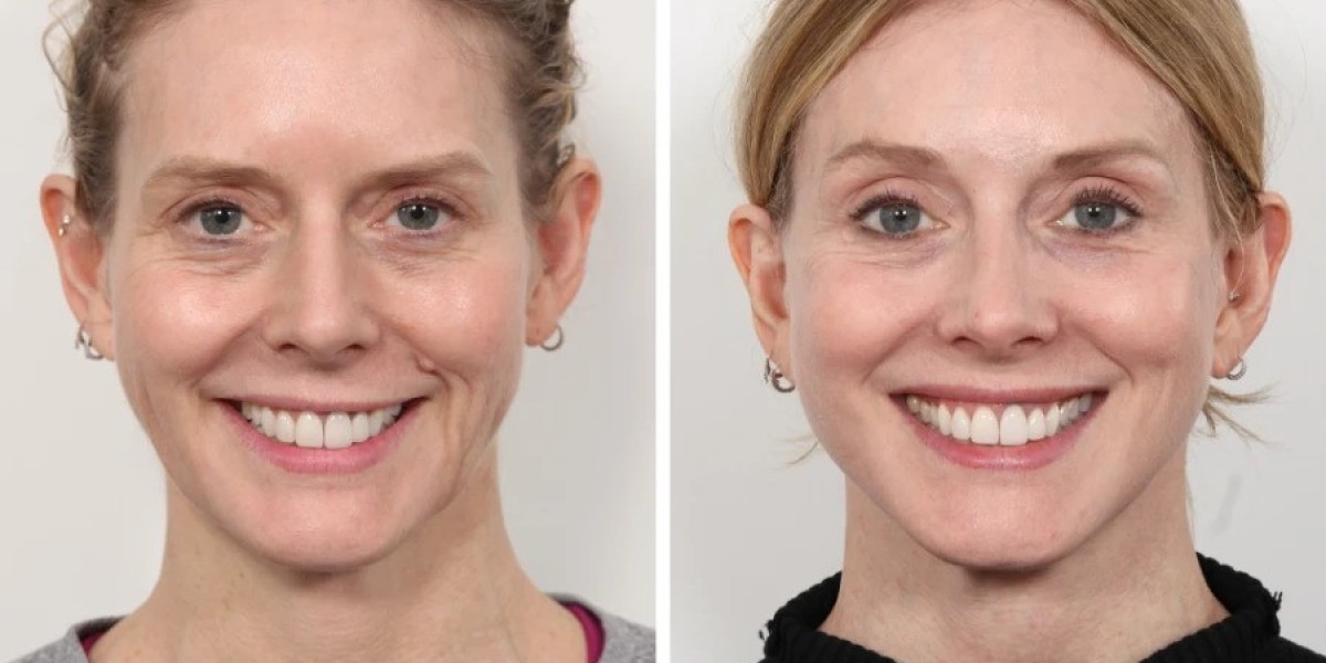 What Makes You a Good Candidate for Thread Lift Treatment in Dubai