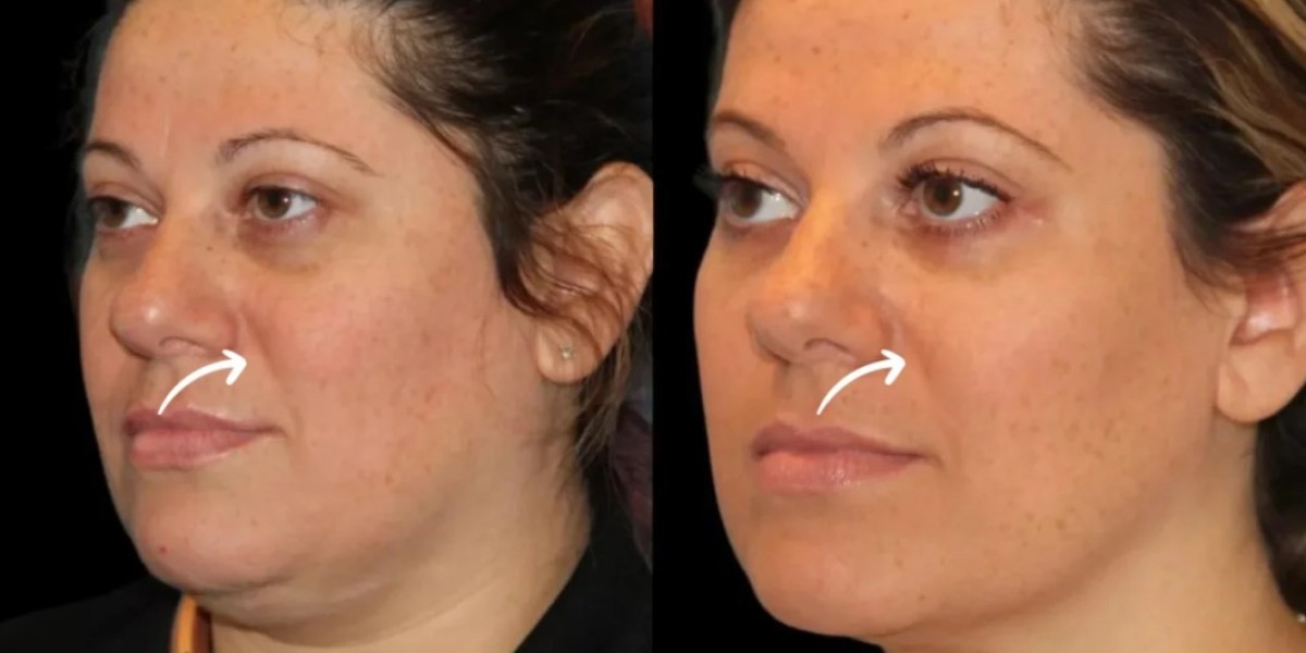 Sculptra Fillers Treatment in Dubai with Polynucleotide Therapy