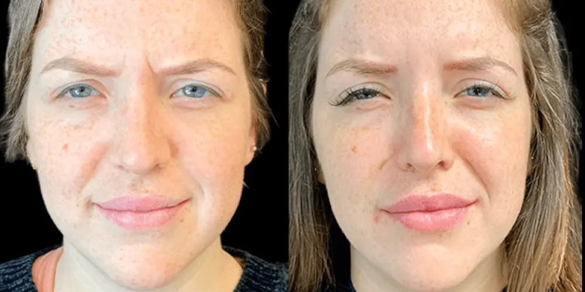 Your Ultimate Guide to Botox Treatments in Dubai in 2026