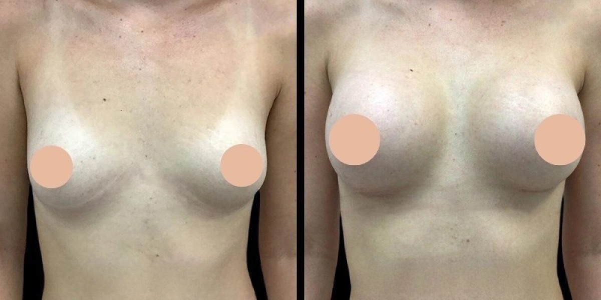 Lifestyle Advice from the Best Breast Augmentation Surgeon in Dubai