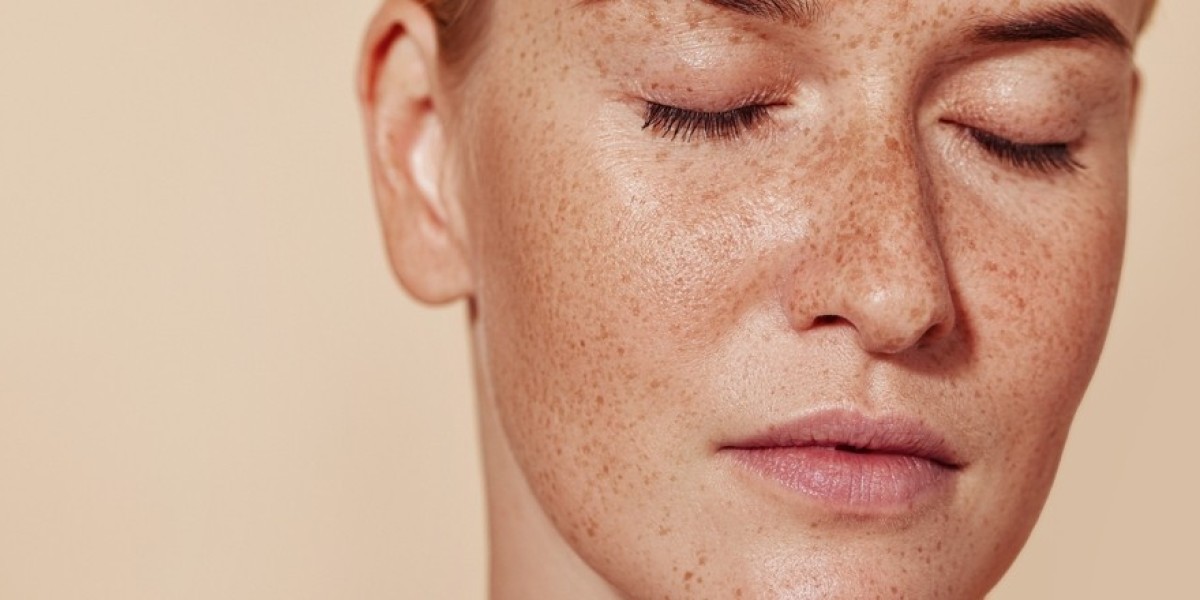 Pigmentation Treatment in Dubai for Melasma: What You Need to Know