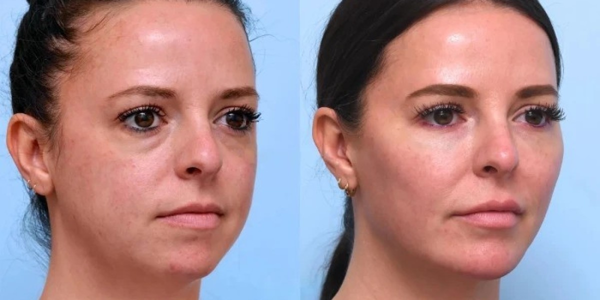 Best Plastic Surgeons in Dubai Delivering Youthful Thread Lift
