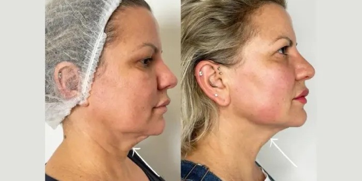 Endolift Treatments in Dubai for Youthful and Firmer Skin