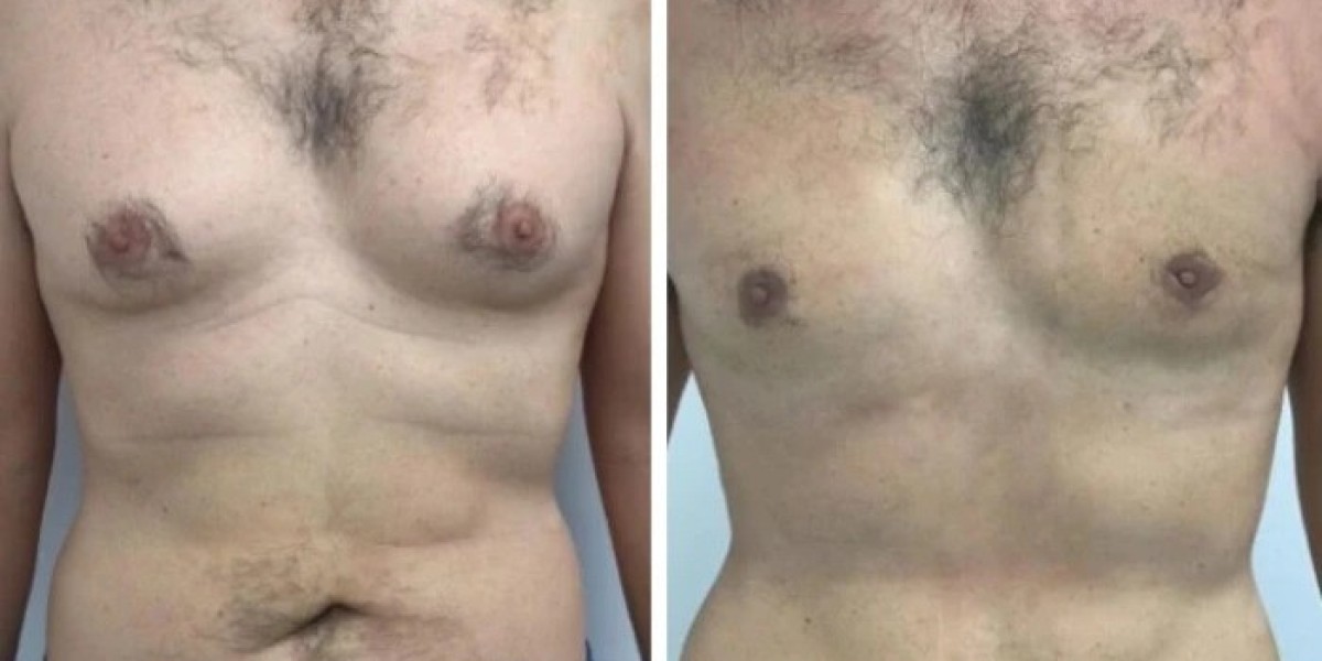 Factors Affecting Gynecomastia Surgery Results: Best Doctors in Dubai